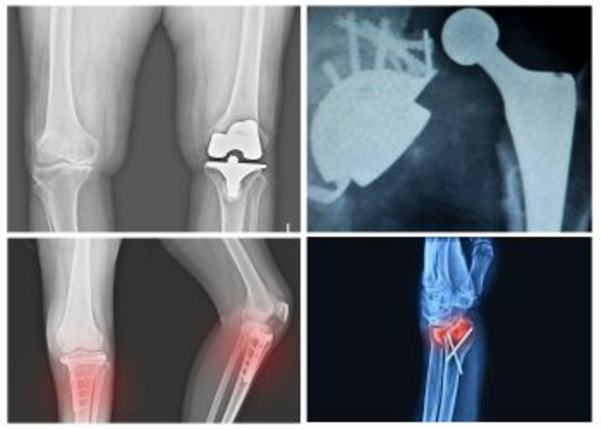 Polytrauma Care (All types of Fractures)